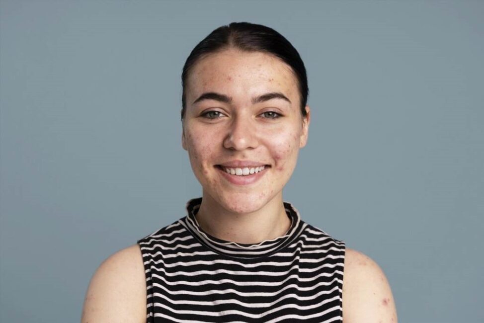 Skuteczne środki łagodzące podrażnienia skóry zamiast wyciskania pryszczy